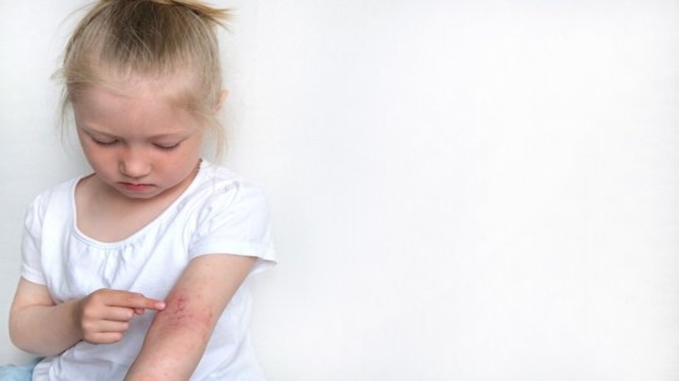 اگزمای کودکان چه تاثیری روی پوست کودک دارد